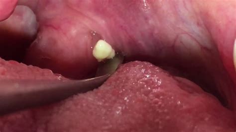 tonsil stones removal